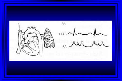 Right Heart Catheterization Swan Ganz Catheter презентация онлайн