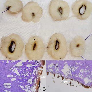 Macroscopic and histopathological examination of the myoma after ex ...