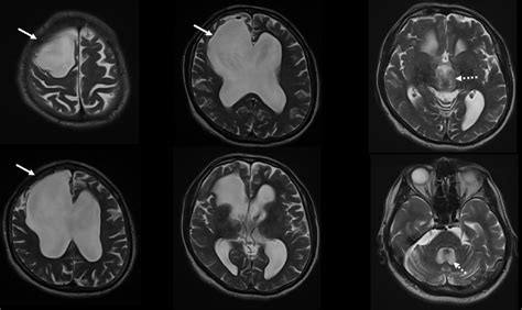 Ventriculoperitoneal Shunt Surgery