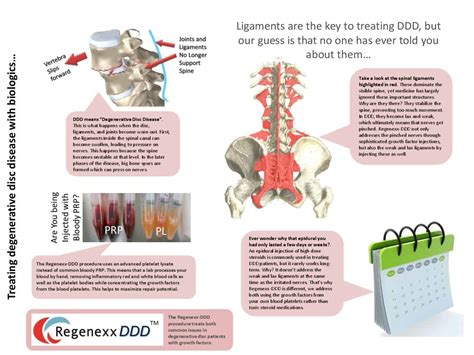 Regenexxddd Procedure Infographic Pdf Regenexx® At New Regeneration Orthopedics