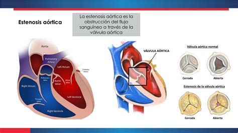 Estenosis E Insuficiencia Aortica Pptx