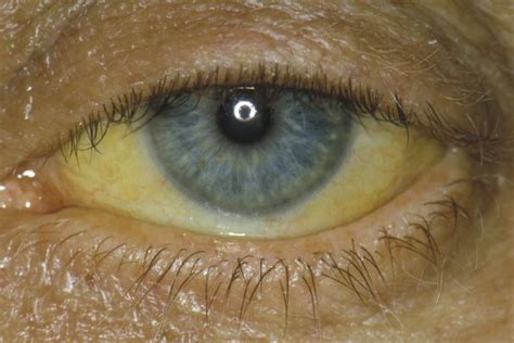 Jaundice Causes Symptoms And Treatment Business Opportunities In