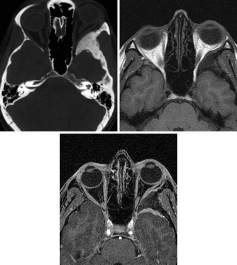 Typical Meningioma The Neurosurgical Atlas