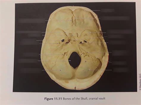 Axial Skeleton Skull Bones Of The Skull Cranial Vault Part 1 Diagram