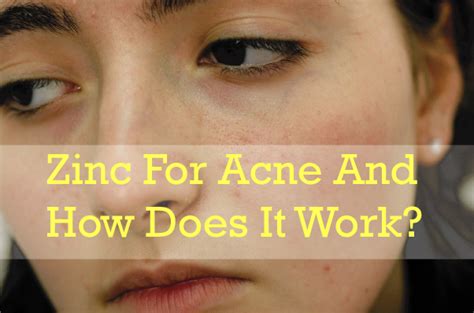 zinc-for-acne-1 | Anti-Aging Young