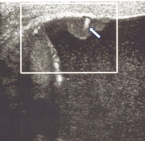 Preoperative Diagnosis Of Malignant Mesothelioma Of The Tunica Vaginalis Using Doppler