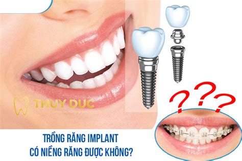 Tổng quan về việc trồng răng implant có niềng răng được không