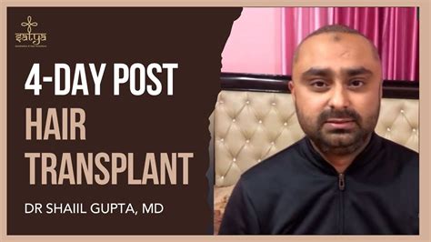 My Hair Transplant Journey 4 Day Post Hair Transplant Result Day By