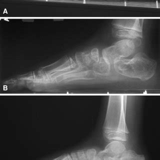 (PDF) Talonavicular Fusion for Dorsal Subluxation of the Navicular in Resistant Clubfoot