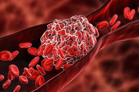 Conheça Os Tipos De Trombose Seus Sintomas E Como Tratar