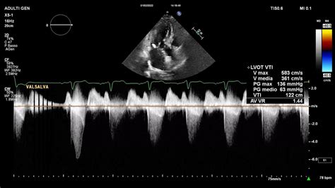 Two Dimensional Trans Thoracic Echocardiogram Continuous Wave Doppler