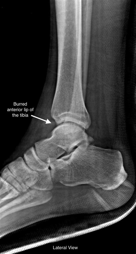 Postoperative Radiograph Of The Right Ankle Lateral V