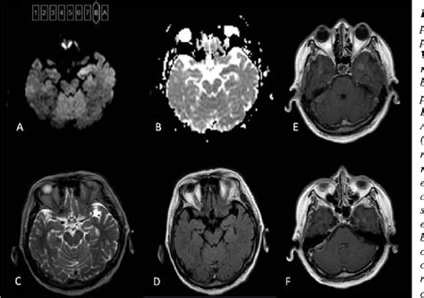 Figure 1 from Bilateral Hippocampus Changes on MRI in Transient Global ...