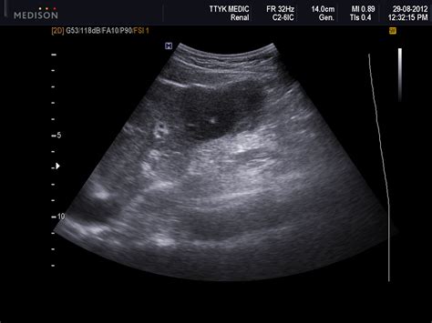 Liver Masses Ultrasound