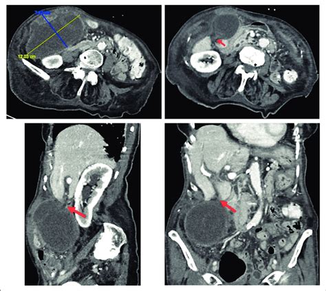 Tc De Abdomen Y Pelvis De La Paciente Que Muestra Una Ves Cula Biliar