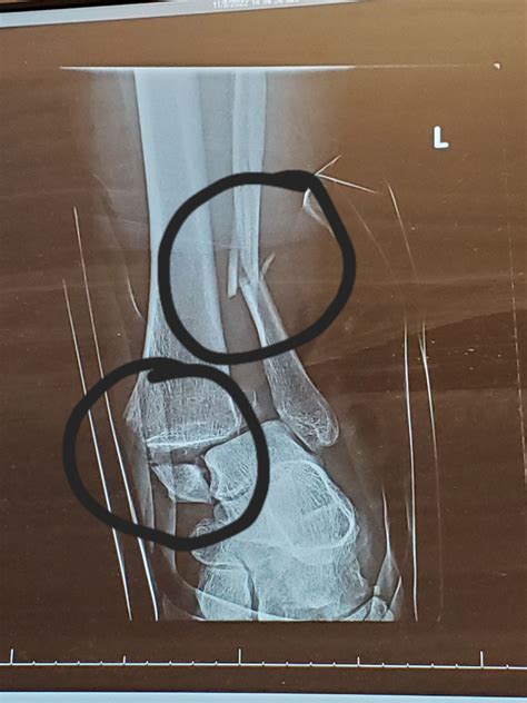 Trimalleolar Ankle Fractures With Ankle Dislocation Rmedicalgore