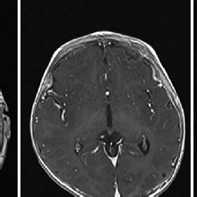 Magnetic Resonance Imaging Brain T1 With Contrast Demonstrates