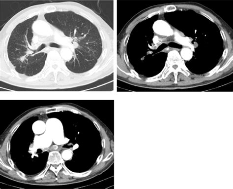 Chest Ct Images Showing Mediastinal And Hilar Lymphadenopathies With Download Scientific