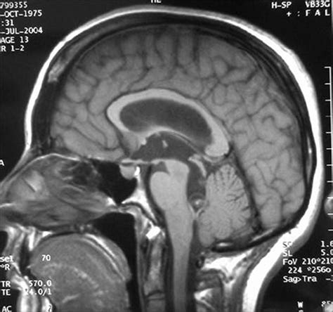 21 Normal Pressure Hydrocephalus Syndrome Secondary To Hemorrhage