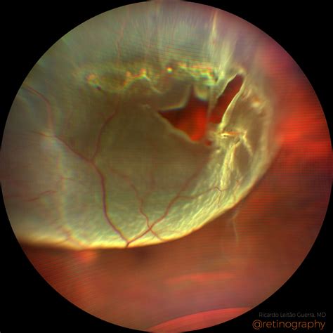 Rhegmatogenous Retinal Detachment Retinography