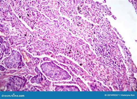 Lung Adenocarcinoma Light Micrograph Stock Image Image Of