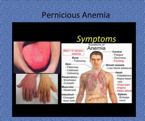 How To Diagnose Pernicious Anemia Riseband2