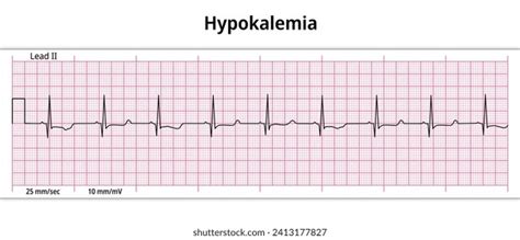 Ecg Hyperkalemia Hyperkalaemia 8 Second Ecg Stock Vector Royalty Free