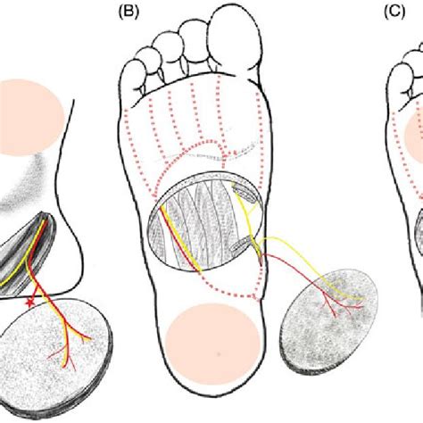 Range Of Applications Of The Medial Plantar Flap A Defect In The Download Scientific Diagram