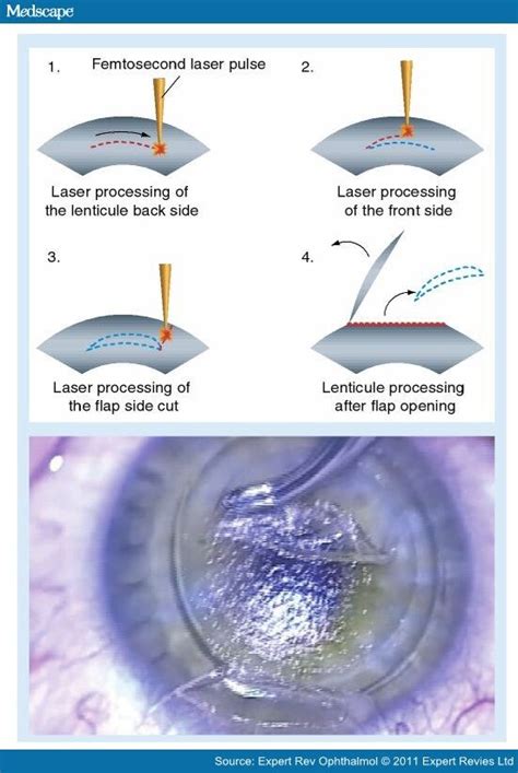 Refractive Surgery Comparison Of Femtosecond Lasers