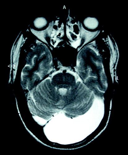 Arachnoid Cyst Posterior Fossa