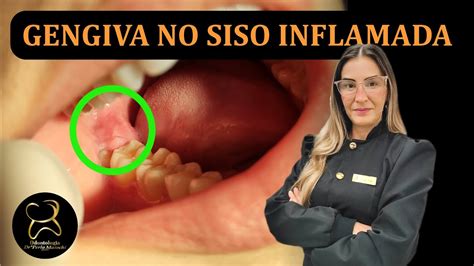 Gengiva Siso Inflamada Como Tratar Youtube