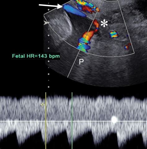 A Radiologists Guide To The Performance And Interpretation Of Obstetric Doppler Us Radiographics