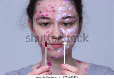 Treatment Concept Symptoms Varicella Zoster Virus Stock Photo ...