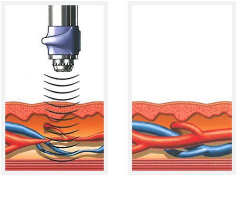 Erectile Dysfunction Treatment Sacramento Gainswave Rocklin Ca