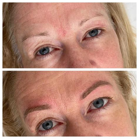 What Is Eyebrow Laser Removal