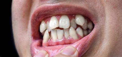 Carii Dentare Tipuri Preventie Si Tratament Gentle Dentist