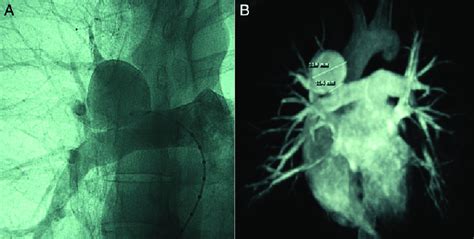 Pulmonary angiography (A) and magnetic resonance imaging (B ...