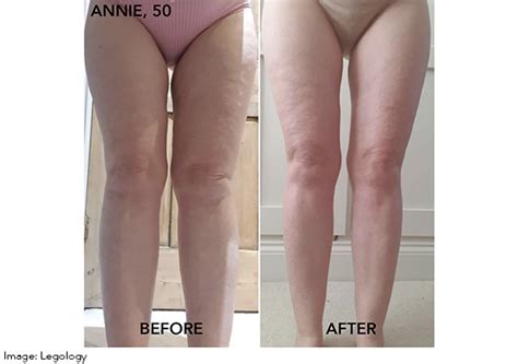 Hnakkur Gosbrunnur Alv Ru Cellulite On Legs Before And After