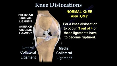 Knee Dislocations Everything You Need To Know Dr Nabil Ebraheim Youtube