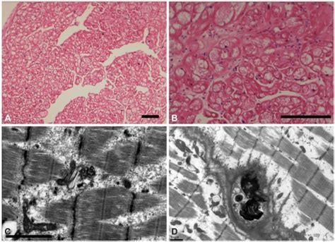 Myocardial Biopsy Findings A And B Light Microscopy Of The Myocardial