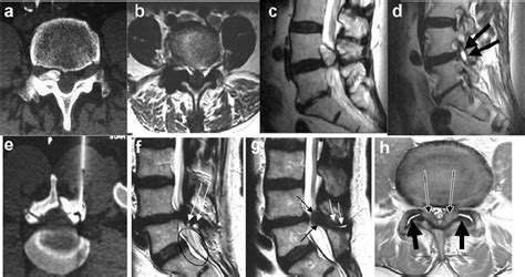 a – h Facet arthrosis (apophyseal joint osteoarthrosis). CT ( a ) and ...