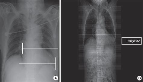 Figure From Calculation Of The Cardiothoracic Ratio From Portable