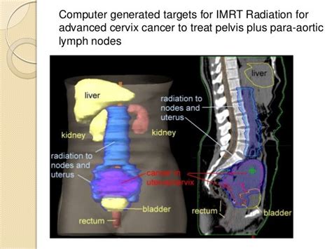 Radiation For Cervix Cancer