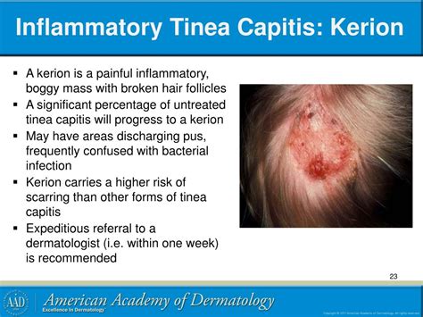 Ppt Pediatric Cutaneous Fungal Infections Powerpoint Presentation Free Download Id 6993108