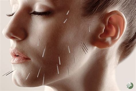 Pin On Acupuncture