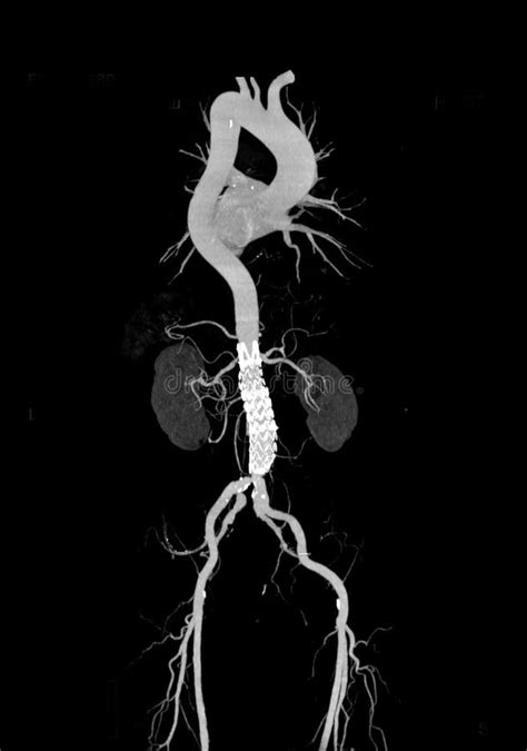 Cta Whole Aorta 3d Rendering Stock Illustration Illustration Of Disease Organ 275737478