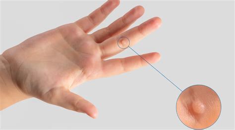 Types De Verrues Comment Les Identifier Et Les Traiter Clinique