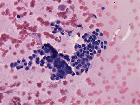 Benign Nodular Hyperplasia