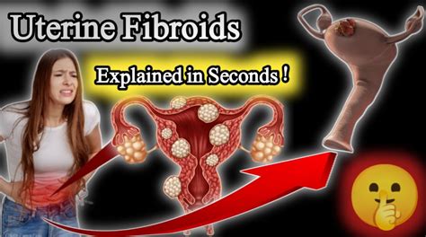 Uterine Fibroids Causes Symptoms And Treatment Explained