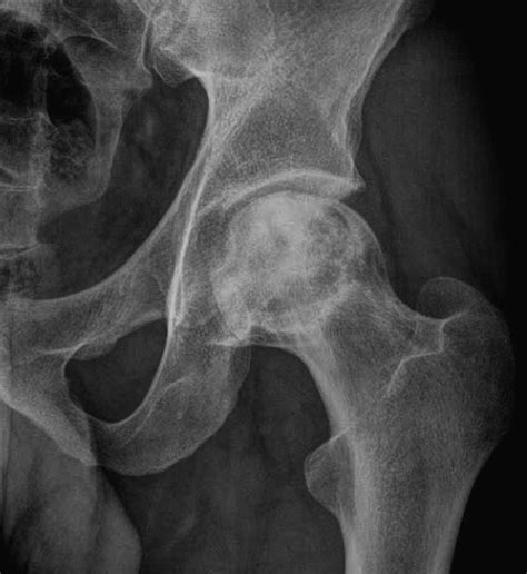 Osteonecrosis Of The Hip